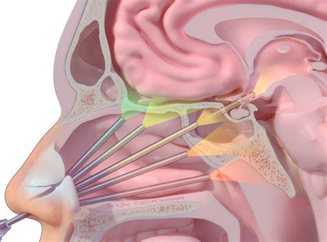 Skull Base Surgery Anatomy Frontiers | Editorial: Endoscopic