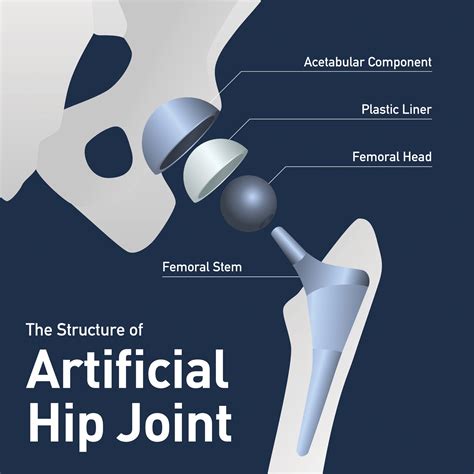 Partial Hip Replacement vs. Total Hip Replacement - USA Spine & Ortho