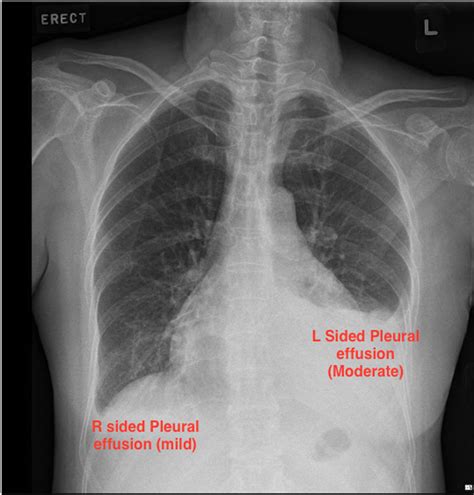 Pleural Effusion X Ray Chest