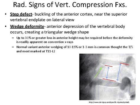 Image result for Compression Fracture Step Defect