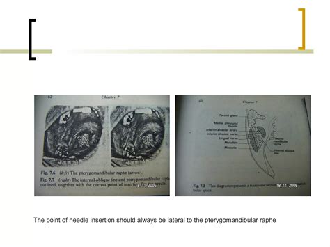 Local Anesthesia Injection 的图像结果