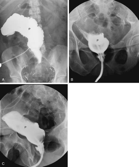 Image result for pouchoscopy