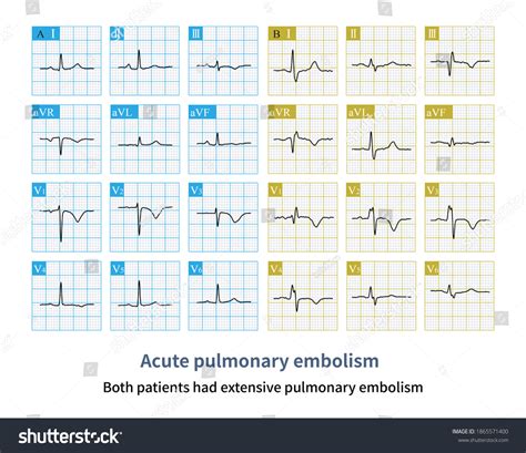 Pulmonary Embolism Ecg