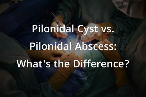 Pilonidal Cyst vs. Pilonidal Abscess: What's the Difference? - Pilonidal