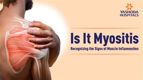 Myositis: Types, Symptoms, Causes, Diagnosis & Treatment