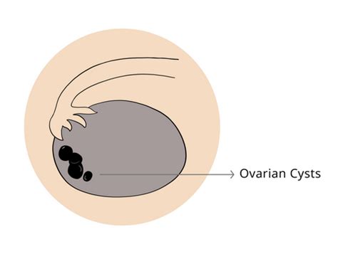 Polycystic Ovarian Syndrome (PCOS) - Basics – Carmesi