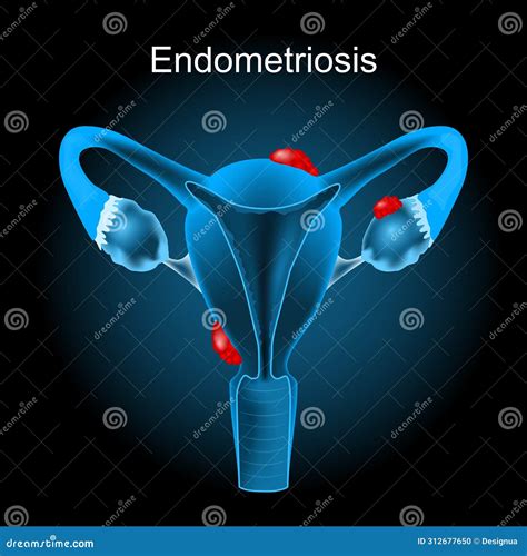Endometriosis. Cross Section of a Human Uterus Stock Vector - Illustration of ovaries, tissue ...