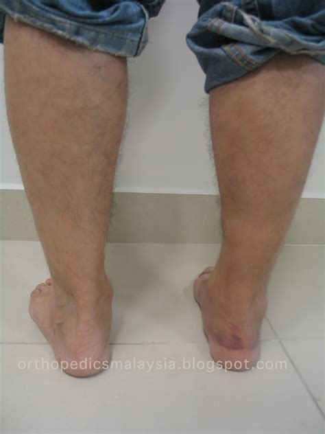 Gastrocnemius Muscle Tear (Calf Tear) | The Orthopedics Malaysia blog