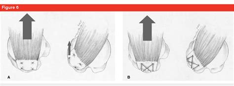 Image result for Single Row Rotator Cuff Repair