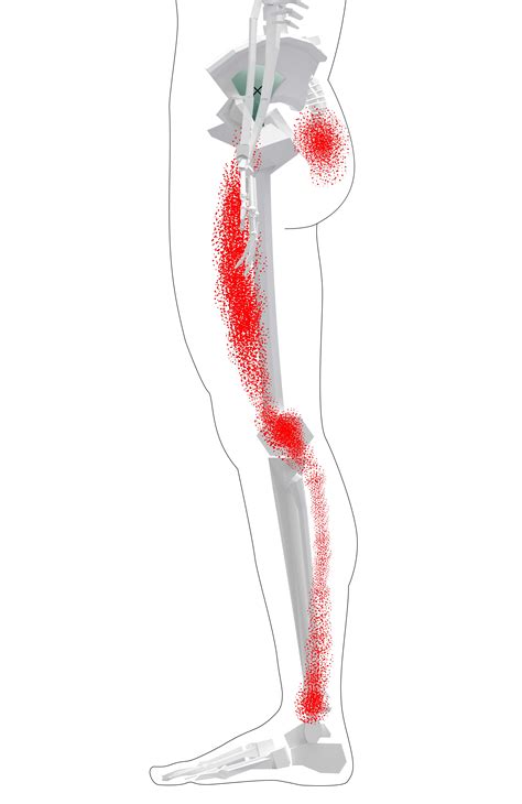 Gluteus Minimus Trigger Points Gym Friendly Hip And Thigh Trigger
