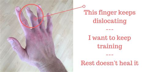 Image result for Finger Dislocation Treatment