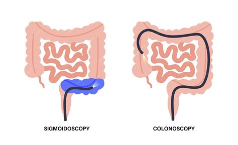 Premium Vector | Colonoscopy and sigmoidoscopy test Examination and treatment of the large ...