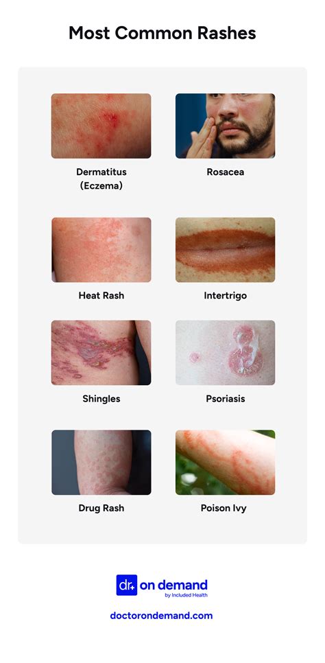 Degrees Of Road Rash Types 0 To 4 Levels Explained
