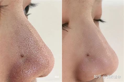 鼻子上的这些黑点是什么，如何除去？ - 知乎