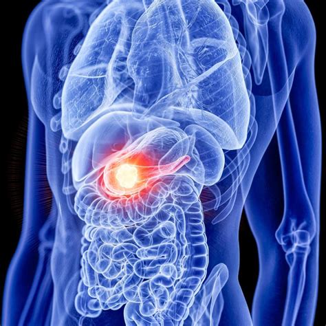 How pancreatic cancer affects your health | South Texas Health System ...