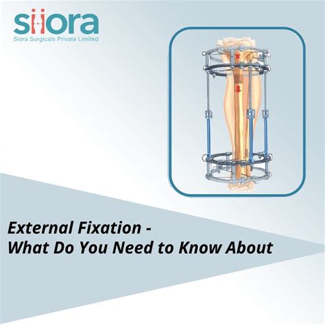 Image result for External Fixation Explained