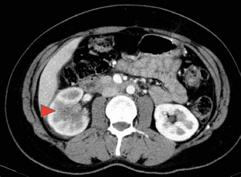 Dr Vivek Venkat Best Surgeon Mumbai. Ureter Cancer Surgery