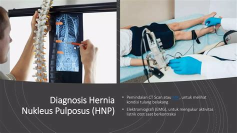 Hernia Nucleus Pulposus ( HNP ).pptx