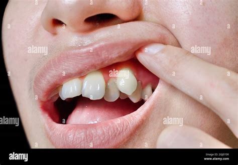 Rezultat imagine pentru Human Sharp Teeth