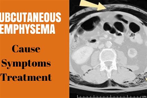 Subcutaneous emphysema: cause, symptoms and treatment