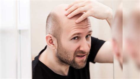 reasons behind baldness among youngsters