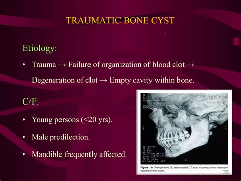 Giant cell lesions of the jaws | PPTX