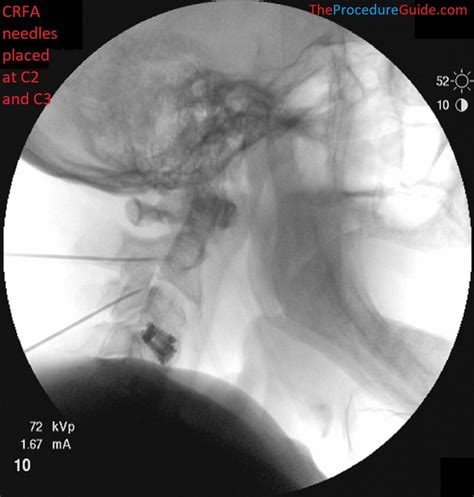 Image result for Fluoroscopy Injection