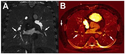 Dual-Energy and Photon-Counting Computed Tomography in Vascular ...