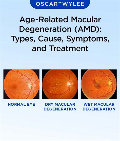 Image result for Macular Degeneration Vision Examples