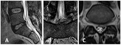 Endoscopic Lumbar Disc Surgery Experience with the TESSYS Technique in ...