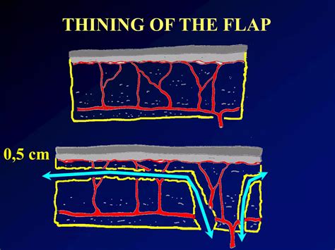 Versatility of anterolateral thigh free flap n. rajacic md | PDF