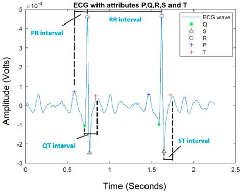 Complexity Analysis in the PR, QT, RR and ST Segments of ECG for Early ...