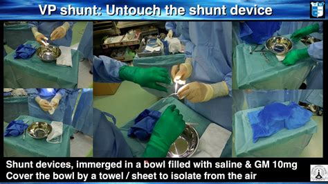 How do I do It - Ventricular Shunt Placement (VP or VA) - ISPN Library