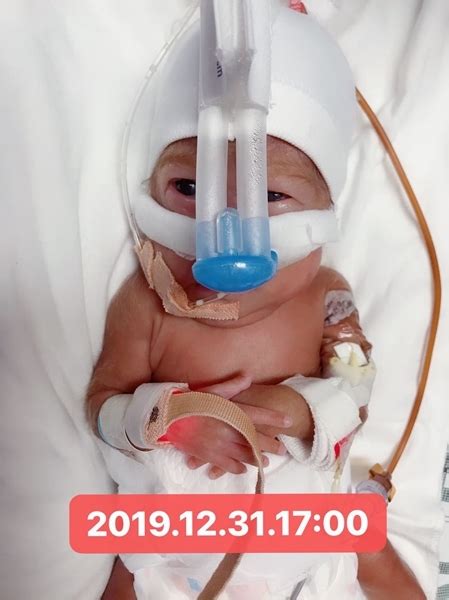 四川省最小胎龄超早产儿出院 出生时仅22周6天_四川在线