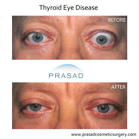 Mechanism Of Thyroid Eye Disease at Jake Spragg blog
