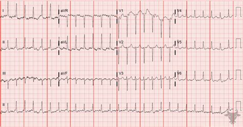 Atrial Flutter | ECG Stampede