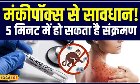 Monkey Pox का तेजी से फैलता खतरा, जानें पूरी सच्चाई! | Causes ...