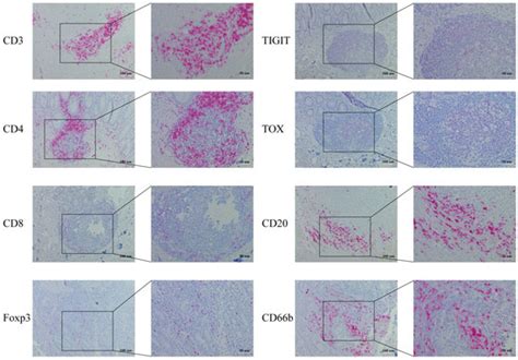 Differential Immune Infiltration Profiles in Colitis-Associated ...