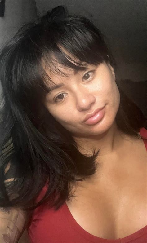 Lip filler dissolved : r/PlasticSurgery