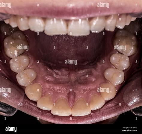 Healthy Bottom Teeth