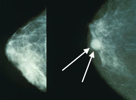 Many Women With Breast Cancer May Not Need Chemo, But Beware Misleading ...
