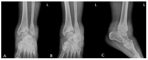 Iatrogenic Ankle Charcot Neuropathic Arthropathy after Spinal Surgery ...