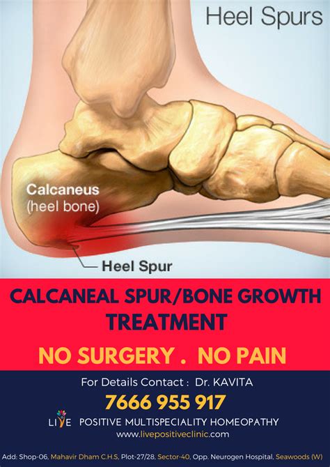 Plantar calcaneal spur treatment. Heel Spur Treatment: Causes, Symptoms ...