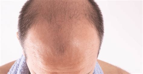 Male Pattern Baldness: Stages, Symptoms & Prevention | Clinikally