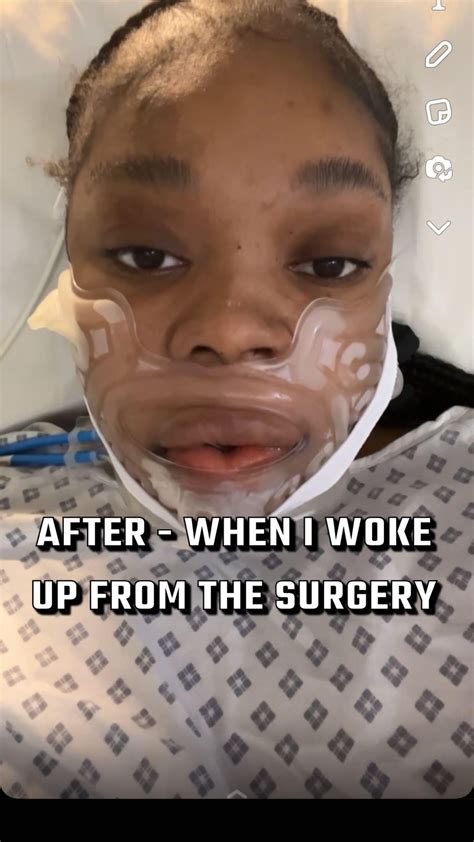 Jaw surgery ruined my face (before/after) : r/jawsurgery