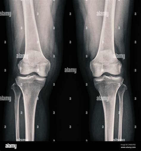 Film x-ray both knee joint AP view showing normal knee joint Stock ...