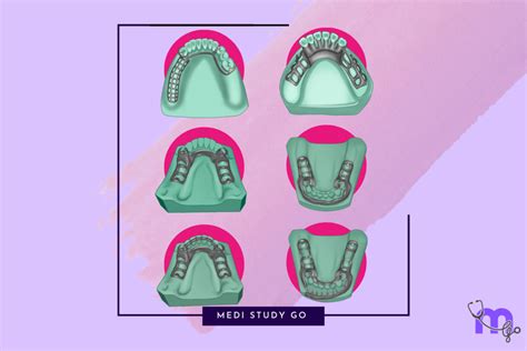 Mandibular Major Connectors: Complete Design Guide – Medi Study Go