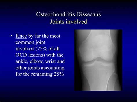 Osteocondritis disecante de rodilla juvenil | PPT
