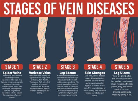 Stages Of Venous Ulcer Healing