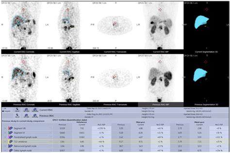 Standardized Uptake Values on SPECT/CT: A Promising Alternative Tool ...